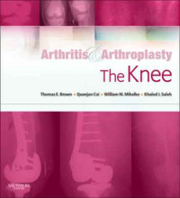 Arthritis & arthroplasty: the knee